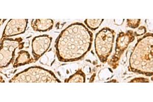 Immunohistochemistry of paraffin-embedded Human thyroid cancer tissue using LRRC2 Polyclonal Antibody at dilution of 1:55(x200) (LRRC2 anticorps)