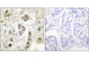 Immunohistochemistry analysis of paraffin-embedded human lung carcinoma tissue, using HSP60 Antibody. (HSPD1 anticorps  (AA 511-560))