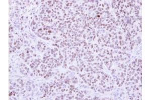 IHC-P Image Immunohistochemical analysis of paraffin-embedded SW480 xenograft, using RCC2, antibody at 1:500 dilution. (RCC2 anticorps)