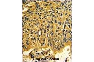Formalin-fixed and paraffin-embedded human lung carcinoma reacted with CDK2 Antibody (C-term), which was peroxidase-conjugated to the secondary antibody, followed by DAB staining. (CDK2 anticorps  (C-Term))