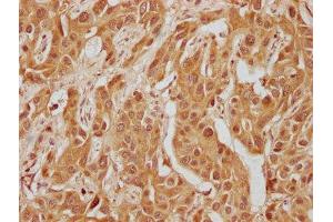 IHC image of ABIN7140235 diluted at 1:300 and staining in paraffin-embedded human liver cancer performed on a Leica BondTM system. (WFIKKN1 anticorps  (AA 187-207))