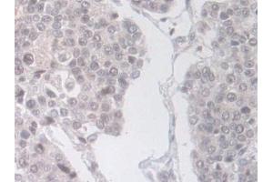 Detection of PLD in Human Pancreatic cancer Tissue using Polyclonal Antibody to Phospholipase D (PLD)