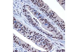 Immunohistochemistry of paraffin-embedded human colon carcinoma using WDR4 Rabbit mAb (ABIN7271355) at dilution of 1:100 (40x lens). (WDR4 anticorps)