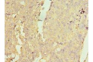 Immunohistochemistry of paraffin-embedded human colon cancer using ABIN7160732 at dilution of 1:100 (PTPDC1 anticorps  (AA 161-235))