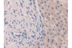 Detection of FGF19 in Human Liver cancer Tissue using Polyclonal Antibody to Fibroblast Growth Factor 19 (FGF19) (FGF19 anticorps  (AA 4-216))