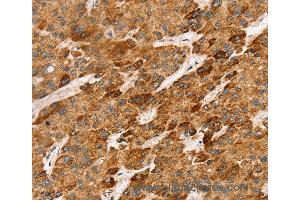 Immunohistochemistry of Human liver cancer using LTB Polyclonal Antibody at dilution of 1:45 (LTB anticorps)