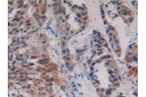 Detection of PKD1 in Human Breast Cancer Tissue using Polyclonal Antibody to Protein Kinase D1 (PKD1) (PKD1 anticorps)