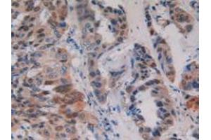 Detection of PKD1 in Human Breast Cancer Tissue using Polyclonal Antibody to Protein Kinase D1 (PKD1) (PKC mu anticorps)