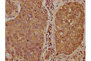IHC image of ABIN7171357 diluted at 1:400 and staining in paraffin-embedded human liver cancer performed on a Leica BondTM system.