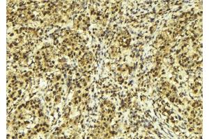 ABIN6279297 at 1/100 staining Human breast cancer tissue by IHC-P. (CHD9 anticorps  (Internal Region))