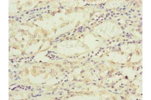 Immunohistochemistry of paraffin-embedded human gastric cancer using ABIN7159902 at dilution of 1:100 (TIMM17B anticorps  (AA 1-172))