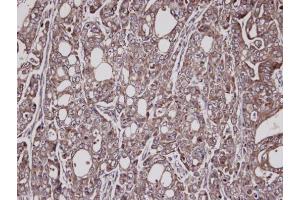 IHC-P Image Immunohistochemical analysis of paraffin-embedded NCI-N87 xenograft, using Lysyl-tRNA synthetase, antibody at 1:100 dilution.