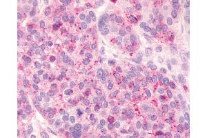 Anti-FKSG80 / GPR81 antibody IHC of human Ovary, Carcinoma.