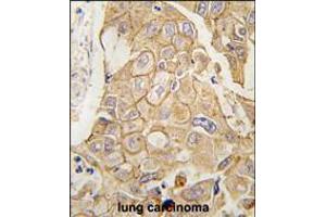 Formalin-fixed and paraffin-embedded human lung carcinoma tissue reacted with ADCY2 antibody , which was peroxidase-conjugated to the secondary antibody, followed by DAB staining. (ADCY2 anticorps  (C-Term))