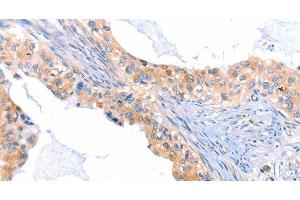 Immunohistochemistry of paraffin-embedded Human cervical cancer tissue using THBS1 Polyclonal Antibody at dilution 1:60 (Thrombospondin 1 anticorps)