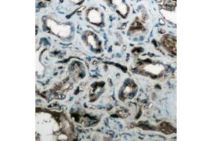 Immunohistochemical analysis of Aquaporin 4 staining in human lung cancer formalin fixed paraffin embedded tissue section. (Aquaporin 4 anticorps  (Center))