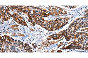 Immunohistochemistry of paraffin-embedded Human esophagus cancer tissue using ITGA7 Polyclonal Antibody at dilution 1:35 (ITGA7 anticorps)