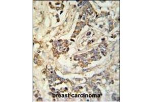 MR Antibody (N-term) 9980a IHC analysis in formalin fixed and paraffin embedded breast carcinoma followed by peroxidase conjugation of the secondary antibody and DAB staining. (MRAP anticorps  (N-Term))
