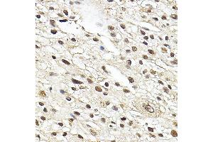 Immunohistochemistry of paraffin-embedded human liver cancer using Glucocorticoid Receptor Rabbit pAb (ABIN3023090, ABIN3023091, ABIN3023092, ABIN1513281 and ABIN6219384) at dilution of 1:100 (40x lens).
