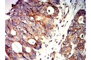 Immunohistochemical analysis of paraffin-embedded rectum cancer tissues using PRKAB2 mouse mAb with DAB staining.