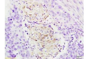 Formalin-fixed and paraffin embedded human esophageal carcinoma tissue labeled with Anti-Cathepsin B Polyclonal Antibody, Unconjugated at 1:200 followed by conjugation to the secondary antibody, (SP-0023), and DAB staining