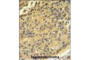 CTSH Antibody (N-term) (ABIN391569 and ABIN2841506) IHC analysis in formalin fixed and paraffin embedded human hepatocarcinoma followed by peroxidase conjugation of the secondary antibody and DAB staining.