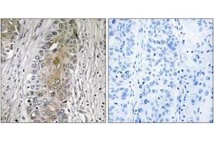 Immunohistochemistry analysis of paraffin-embedded human lung carcinoma, using SAA4 Antibody. (SAA4 anticorps  (AA 81-130))