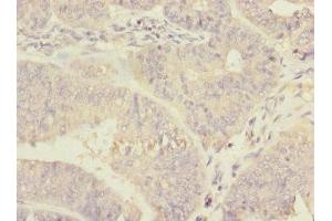 Immunohistochemistry of paraffin-embedded human endometrial cancer using ABIN7150598 at dilution of 1:100 (Ribophorin II anticorps  (AA 360-540))