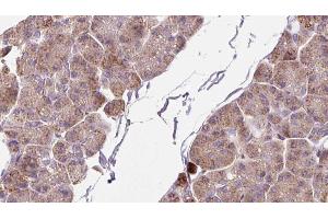 ABIN6273262 at 1/100 staining Human pancreas cancer tissue by IHC-P. (DHX58 anticorps  (Internal Region))