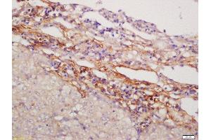 Formalin-fixed and paraffin embedded human lung carcinoma labeled with Anti-NFAM1 Polyclonal Antibody, Unconjugated  at 1:200 followed by conjugation to the secondary antibody and DAB staining