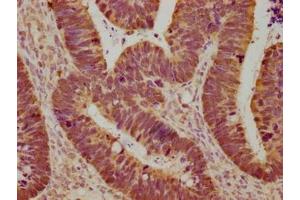 Immunohistochemical of paraffin-embedded human ovarian cancer using ABIN7153439 at dilution of 1:100
