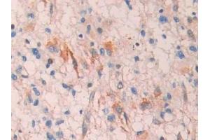 Detection of LOXL4 in Human Glioma Tissue using Polyclonal Antibody to Lysyl Oxidase Like Protein 4 (LOXL4)