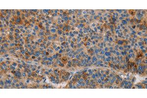 Immunohistochemistry of paraffin-embedded Human liver cancer using AMBP Polyclonal Antibody at dilution of 1:55 (AMBP anticorps)