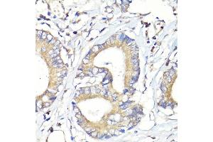 Immunohistochemistry of paraffin-embedded human colon carcinoma using HB-EGF antibody (ABIN7267617) at dilution of 1:100 (40x lens). (HBEGF anticorps  (AA 20-160))