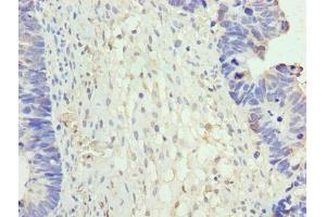 Immunohistochemistry of paraffin-embedded human ovarian cancer using ABIN7161852 at dilution of 1:100 (NR2C2AP anticorps  (AA 7-139))