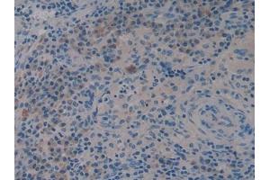 Detection of WNT3A in Human Skin cancer Tissue using Polyclonal Antibody to Wingless Type MMTV Integration Site Family, Member 3A (WNT3A)