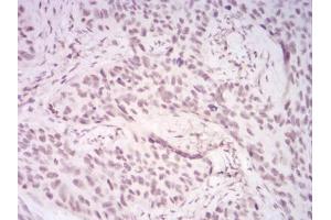 Immunohistochemical analysis of paraffin-embedded cervical cancer tissues using DDX39B mouse mAb with DAB staining. (DDX39B anticorps  (AA 1-250))