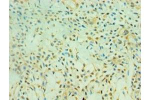 Immunohistochemistry of paraffin-embedded human breast cancer using ABIN7160859 at dilution of 1:100