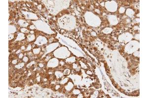 IHC-P Image Immunohistochemical analysis of paraffin-embedded OVCA xenograft, using 14-3-3 sigma, antibody at 1:100 dilution.