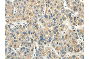 The image on the left is immunohistochemistry of paraffin-embedded Human liver cancer tissue using ABIN7190243(CHGB Antibody) at dilution 1/30, on the right is treated with synthetic peptide.