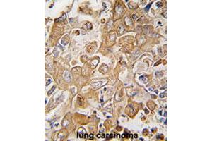 Formalin-fixed and paraffin-embedded human lung carcinomareacted with LECT1 polyclonal antibody , which was peroxidase-conjugated to the secondary antibody, followed by AEC staining. (LECT1 anticorps  (C-Term))