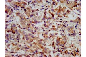 IHC image of ABIN7156004 diluted at 1:400 and staining in paraffin-embedded human liver cancer performed on a Leica BondTM system. (HMGCS2 anticorps  (AA 426-508))