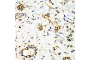 Immunohistochemistry of paraffin-embedded human liver cancer using NRBF2 antibody.