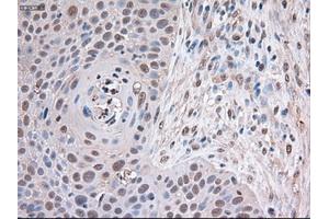 Immunohistochemical staining of paraffin-embedded Adenocarcinoma of breast using anti-Trim33 (ABIN2452534) mouse monoclonal antibody (TRIM33 anticorps  (AA 887-1046))