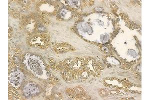 MGAT5 Mouse Monoclonal Antibody at 1/100 staining human ovarian cancer by IHC-P. (MGAT5 anticorps)
