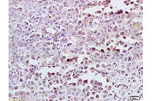Formalin-fixed and paraffin embedded mouse lymphoma tissue labeled with Anti-CDK4 Polyclonal Antibody (ABIN671166), Unconjugated at 1:300, followed by conjugation to the secondary antibody and DAB staining (CDK4 anticorps  (AA 241-303))