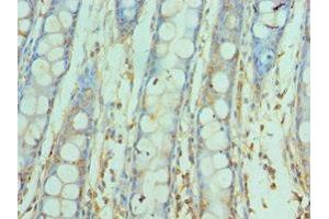 Immunohistochemistry of paraffin-embedded human colon cancer using ABIN7171146 at dilution of 1:100 (SNAP25 anticorps  (AA 1-206))