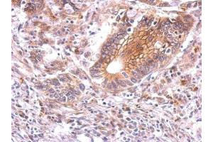 IHC-P Image beta Catenin antibody detects CTNNB1 protein at membrane on human gastric cancer by immunohistochemical analysis. (CTNNB1 anticorps)