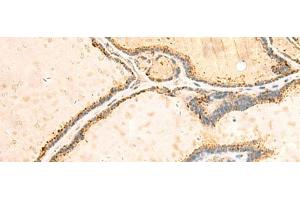 Immunohistochemistry of paraffin-embedded Human thyroid cancer tissue using IGFBPL1 Polyclonal Antibody at dilution of 1:55(x200) (IGFBPL1 anticorps)