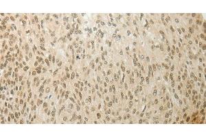 Immunohistochemistry of paraffin-embedded Human cervical cancer using MYSM1 Polyclonal Antibody at dilution of 1:60